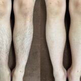 当店のメニュー紹介①脱毛について