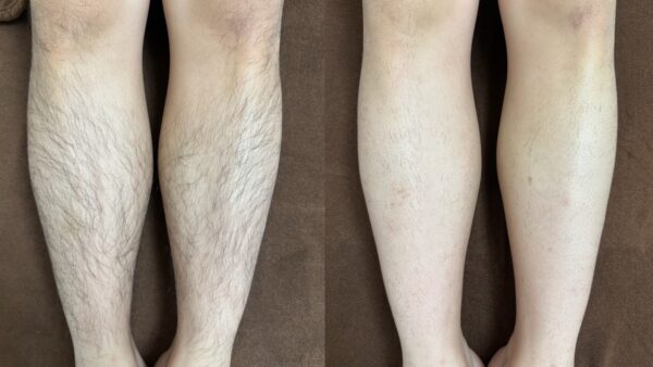 当店のメニュー紹介①脱毛について